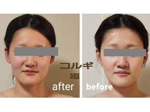 セレブリティ(Celebrity)/コルギ小顔