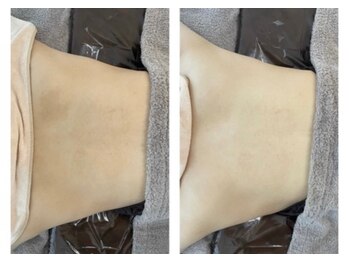 エヌエクラ(N.eclat.)/背中ケア