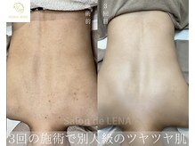 サロンドレナ 名駅店/ハーブピーリング サロンドレナ