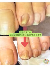 フローラ(Flora)/小さな爪も巻き爪矯正できます！