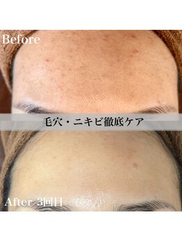 アール アンド ビューティーサロン(Ｒ＆ BeautySalon)/メンズにも人気！ニキビ予防に◎