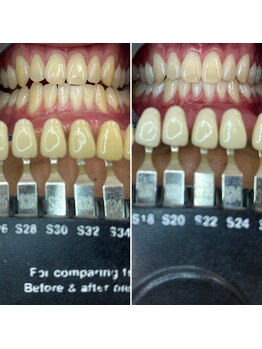 トウキョウスワーズ 池袋店(TOKYO SWRS)/#ホワイトニング #池袋 #渋谷