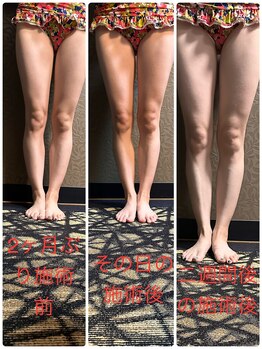 チュラ/ハイパーナイフ/所沢/痩身エステ