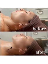 サリーエミリー 北千住店(SallyEmiry)/小顔コルギビフォーアフター