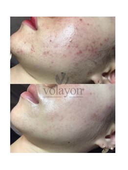 ヴィエルバ(VIELVA)/