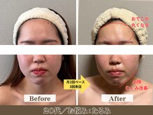 コガオラボ 甲府店(KOGAO LABO)/お客様☆Before&After☆