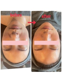 ダリア(Dahlia)/ハーブピーリング