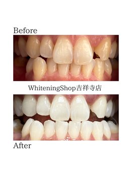 ホワイトニングショップ 吉祥寺店/【ビフォーアフター】