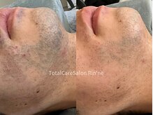 リンネ(Rin'ne)/[メンズ髭脱毛] 脱!毎日の髭剃り