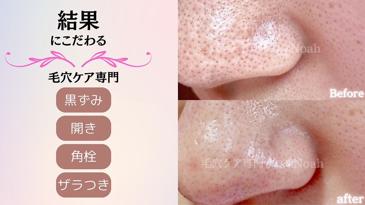 毛穴ケア専門店｜ホットペッパービューティー