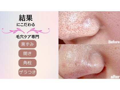 毛穴ケア専門店の写真