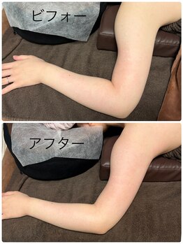 メディカルエステ ユウ(Yuu)/痩せにくい二の腕もスッキリ