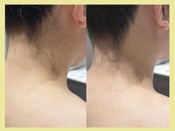 リタ 銀座(Rita)/襟足/うなじシェービング