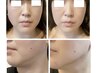 【二重あごが気になる方】フェイスラインのもたつき集中ケア　初回お試し