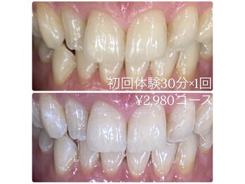 ホワイトニングルーム 横浜店(Whitening Room)/ホワイトニング/横浜