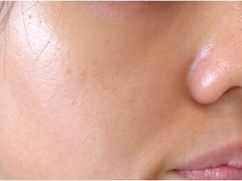 レピア(Le'pia)の写真/黒ずみ/テカリ/開きの毛穴タイプ診断→肌質に合わせたケアでお肌を育てながら改善へと導きます☆