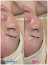 フィロ柏整骨院(Philo柏整骨院)/お背中～肩首～フェイシャル