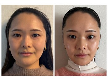 ココ(COCO)/口横たるみ/頬こけ/リフトアップ