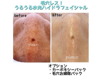 プランス 福岡(PLANCE)/毛穴の黒ずみ/福岡天神エステ