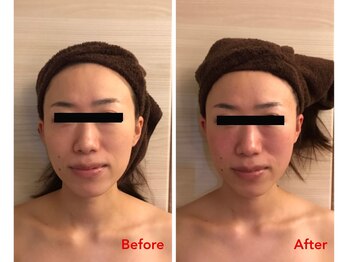 アイリス(AIRIS)/小顔にお悩みの方