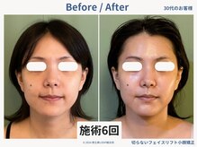 グロウズ(Glows)/フェイスラインがシャープに