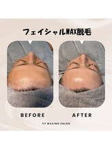 トリプルワン(111)/フェイシャルWAX脱毛