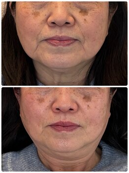 クレル(Clair)/70代 before→after