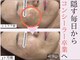 ミニョン(Mignon)の写真