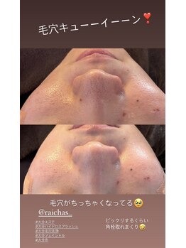 ライチャス(RAICHAS)/ハイドロフェイシャル