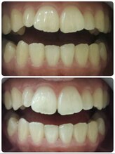 ジョルフ サロン オリジナル(JOLF salon original)/セルフホワイトニング