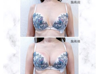 サロン アンネ(Anne)/本格エステ豊胸プログラム