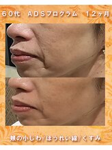 ナイア(naia)/リセラADS使用症例