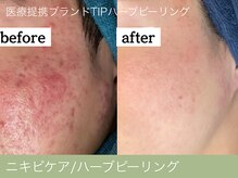 オーエン 小倉店(o-eN)/ニキビケア/ハーブピーリング