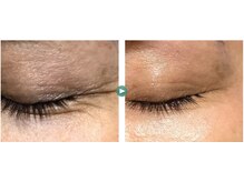 ハルリ(Haruri)/幹細胞導入でシワ改善