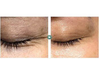 ハルリ(Haruri)/幹細胞導入でシワ改善