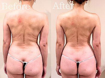 ナリッシュ バスト 六本木(Nouriche Bust)/筋膜リリースでバストアップ！