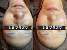 サロン フェリシア(salon Felicia)の雰囲気（シミでお悩みの方に！シミプラズマでターンオーバー透明感もUP！）