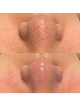 ミューズ(MUSE)/毛穴エクストラクション＋顔脱毛