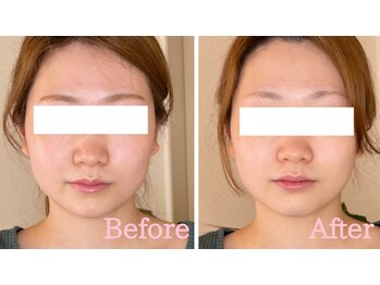 小顔矯正サロン ブルーム/施術1回のビフォーアフター
