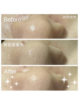 ファインスキン 新宿店(Fine Skin)/毛穴洗浄 Before After
