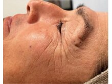 リベル 名古屋(Lebelle:)/ハーブピーリング専門名古屋