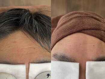 ルーチェ/【光フェイシャル】before after