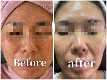 アズ(AZU)/肌改善Before after