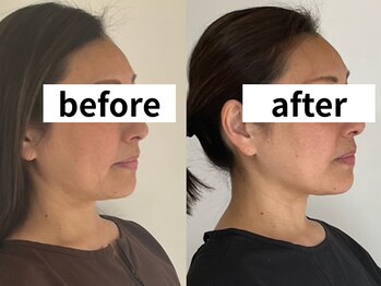 耀 カガヤキ/美容鍼