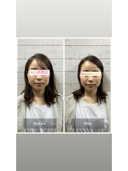 カラダプラス(kArAdA+)/小顔矯正ビフォーアフター女性