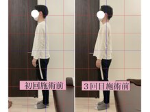 弁天町駅前整体院/首肩整体の施術前後比較