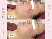 ルア(LuA.)/頑固なニキビも改善！