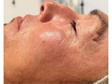 リベル 名古屋(Lebelle:)/ハーブピーリング専門名古屋