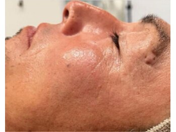 リベル 名古屋(Lebelle:)/ハーブピーリング専門名古屋