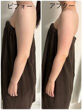 メディカルエステ ユウ(Yuu)/背中、二の腕　